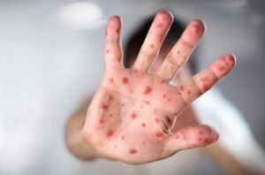 Saúde alerta para cuidados redobrados com o sarampo